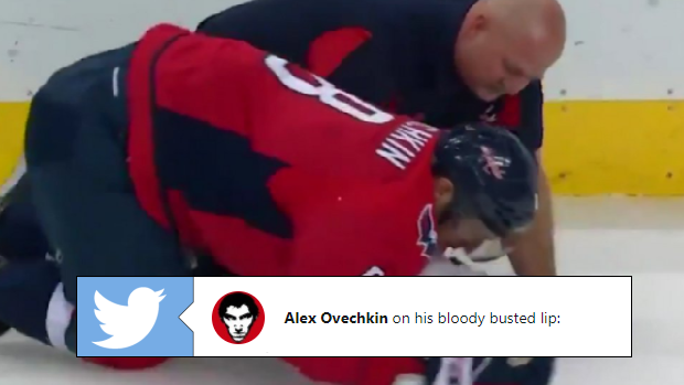 Alexander Ovechkin after taking a puck to the face.