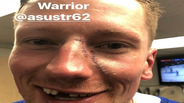Andrej Sustr Shared a Gruesome Photo of Cut on His Face Following Fight