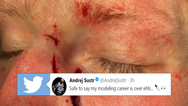 Andrej Sustr Shared a Gruesome Photo of Cut on His Face Following Fight